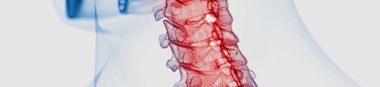 Artrose Cervical